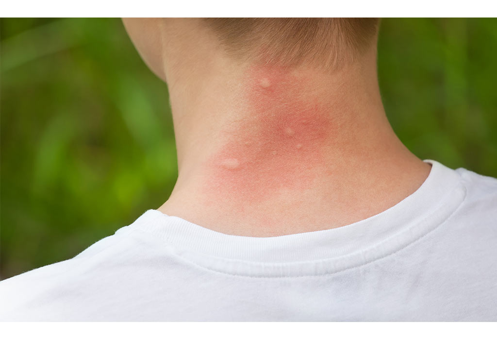 Mosquito Bites