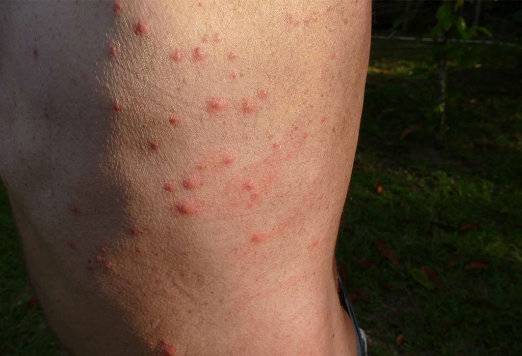 Bed Bug Bites