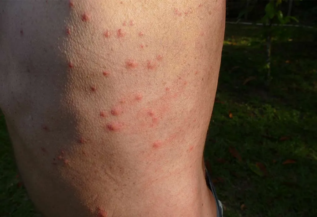 Bed Bug Bites