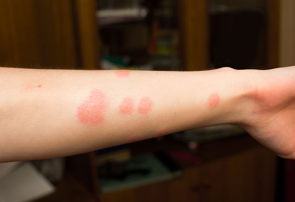 Flea Bites