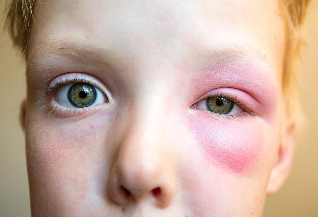 Bee Stings