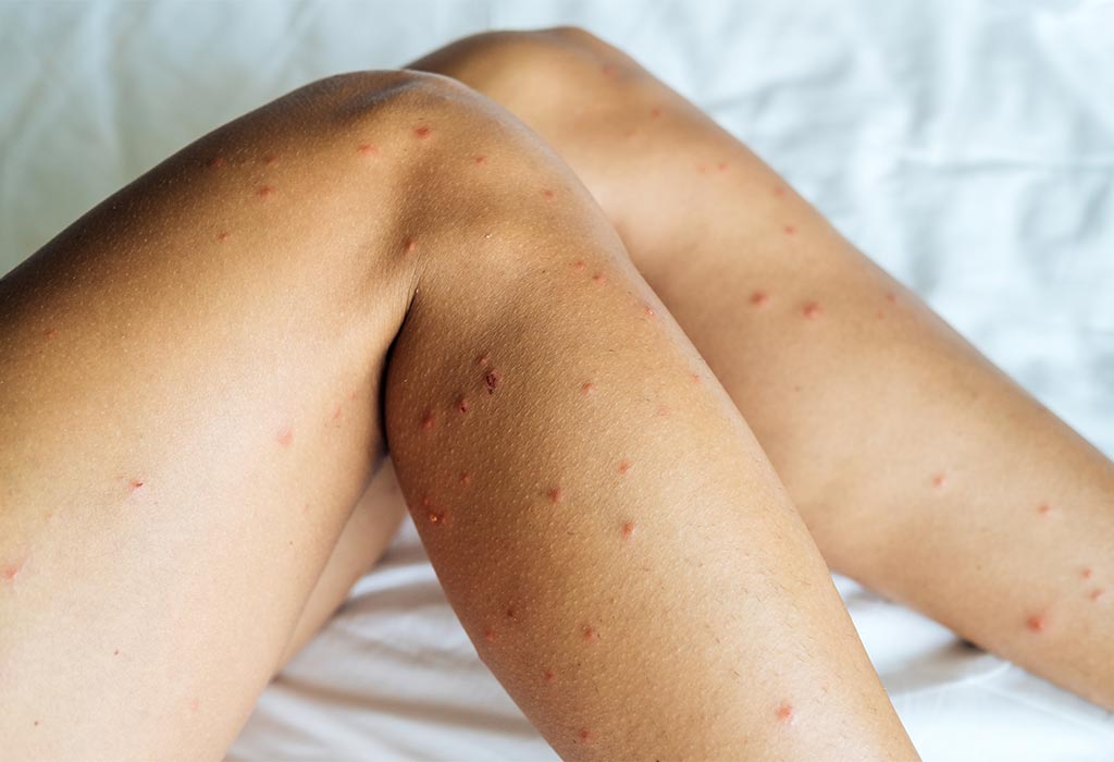 Fly Bites