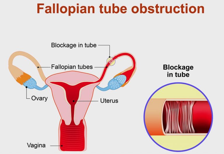 Natural Treatment for Blocked Fallopian Tubes