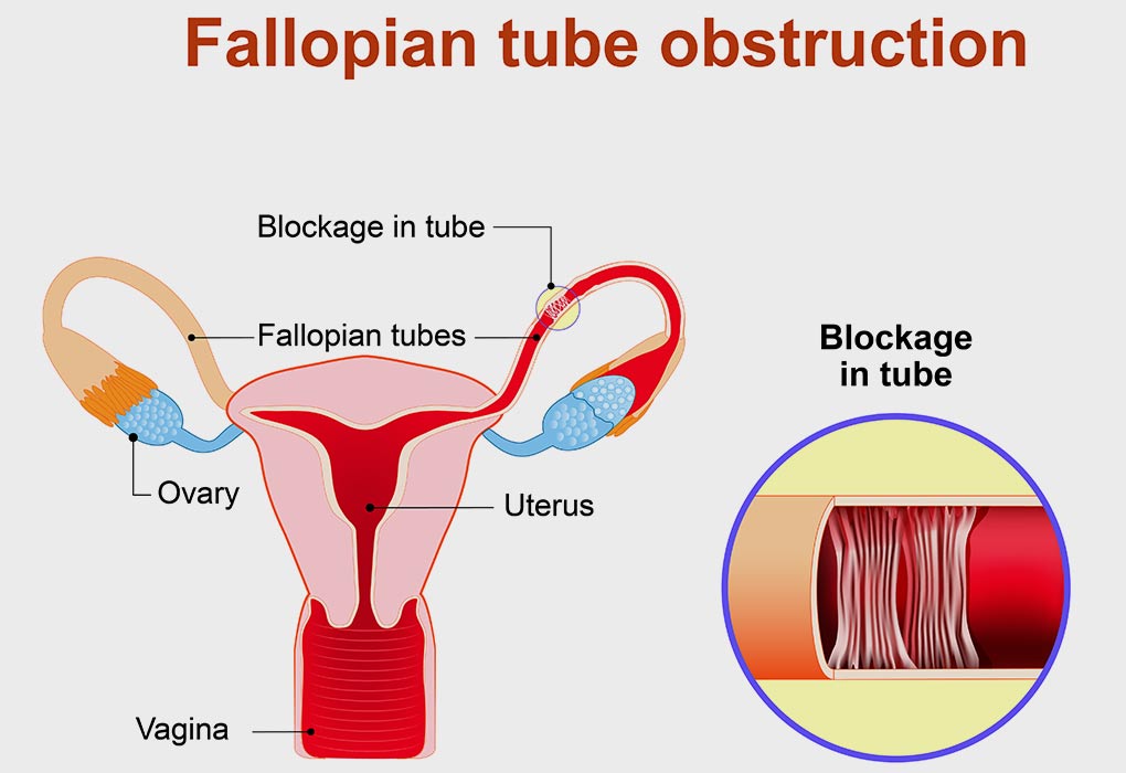 List Of 16 Natural Treatment For Blocked Fallopian Tubes