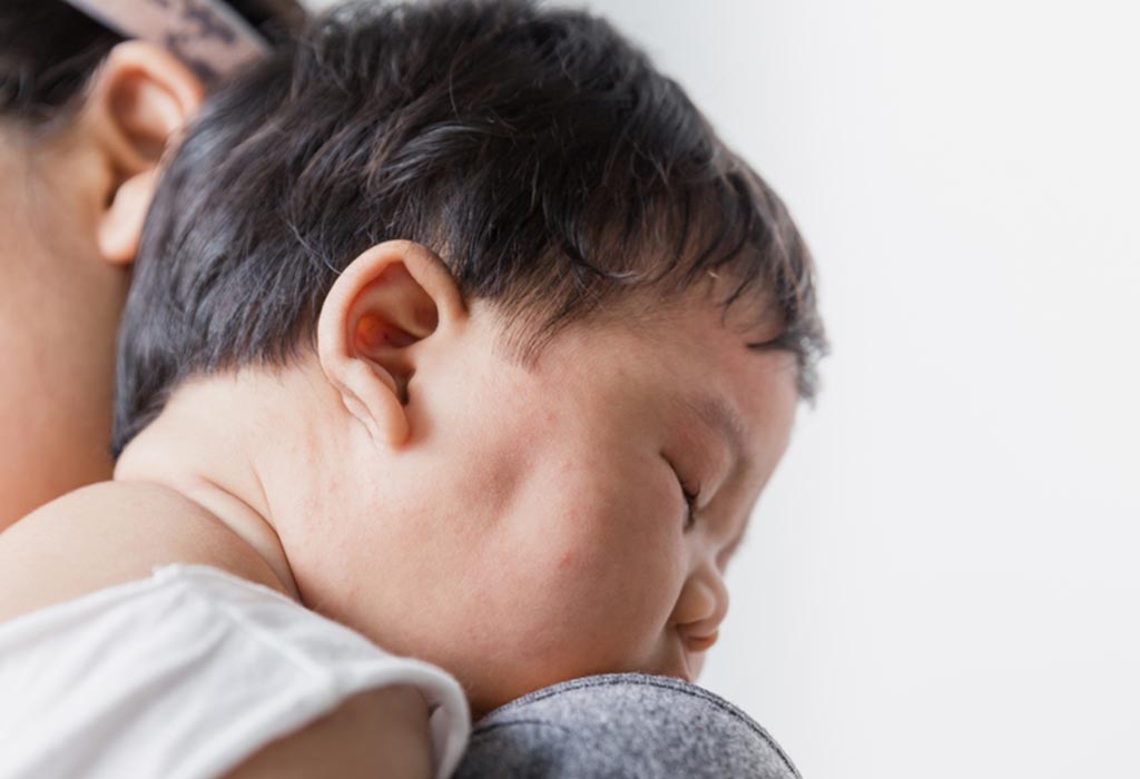 10 Home Remedies Heat Rash in Babies