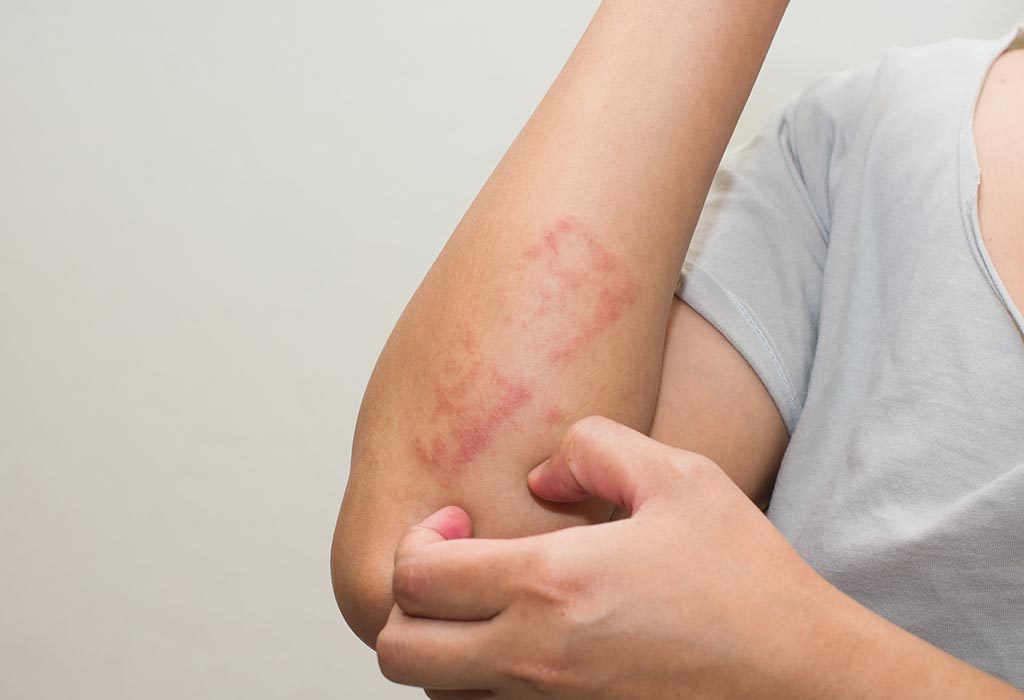 Eczema During Pregnancy Types Causes Signs Treatment