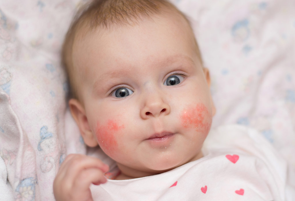 Eczema In Children Causes Signs Treatment Home Remedies