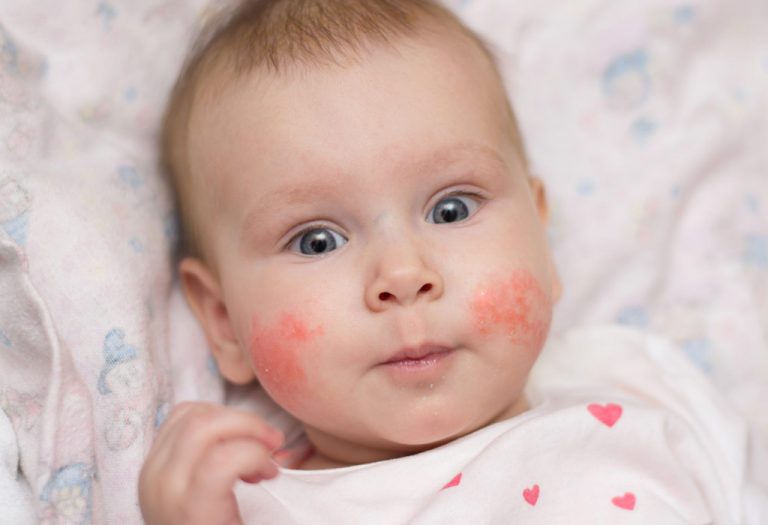Sunburn in Babies - Symptoms, Treatment and Prevention