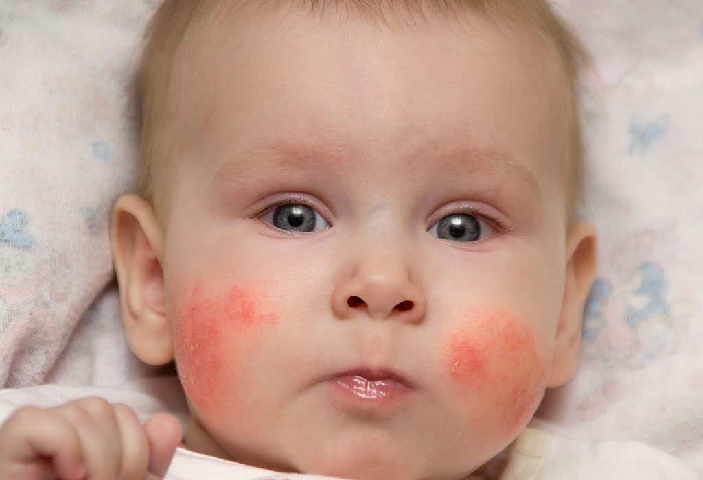 baby face rash cream