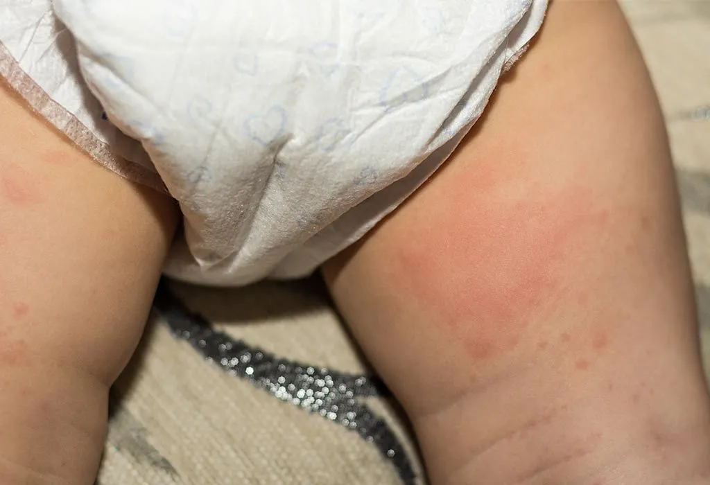 Signs & Symptoms of Yeast Diaper Rash in Infants
