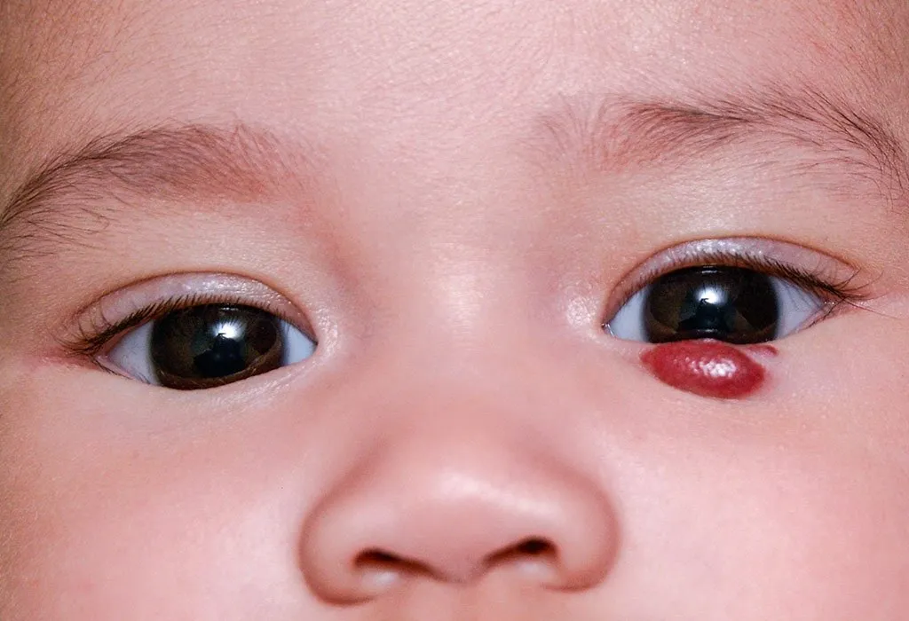 Infantile Hemangioma Causes, Symptoms and Treatment