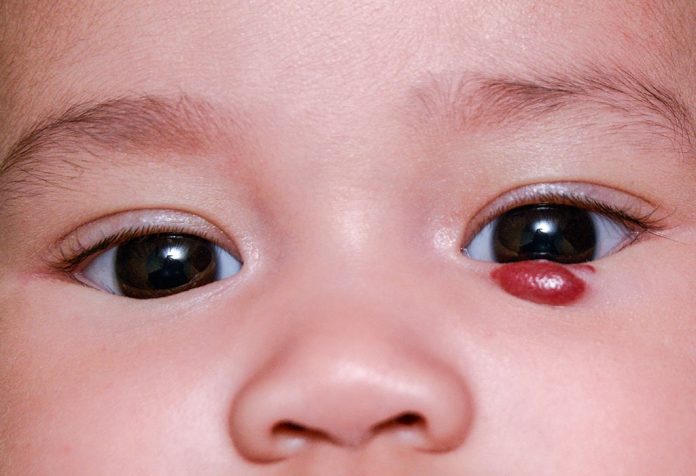 Infantile Hemangioma - Causes, Complications and Treatment