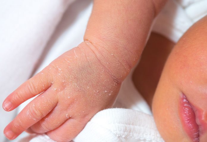 Peeling Skin in Newborns - Why Does It Happen?