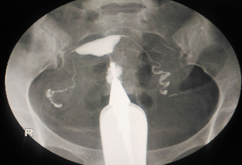 Ultrasoonbeeld van gekantelde baarmoeder