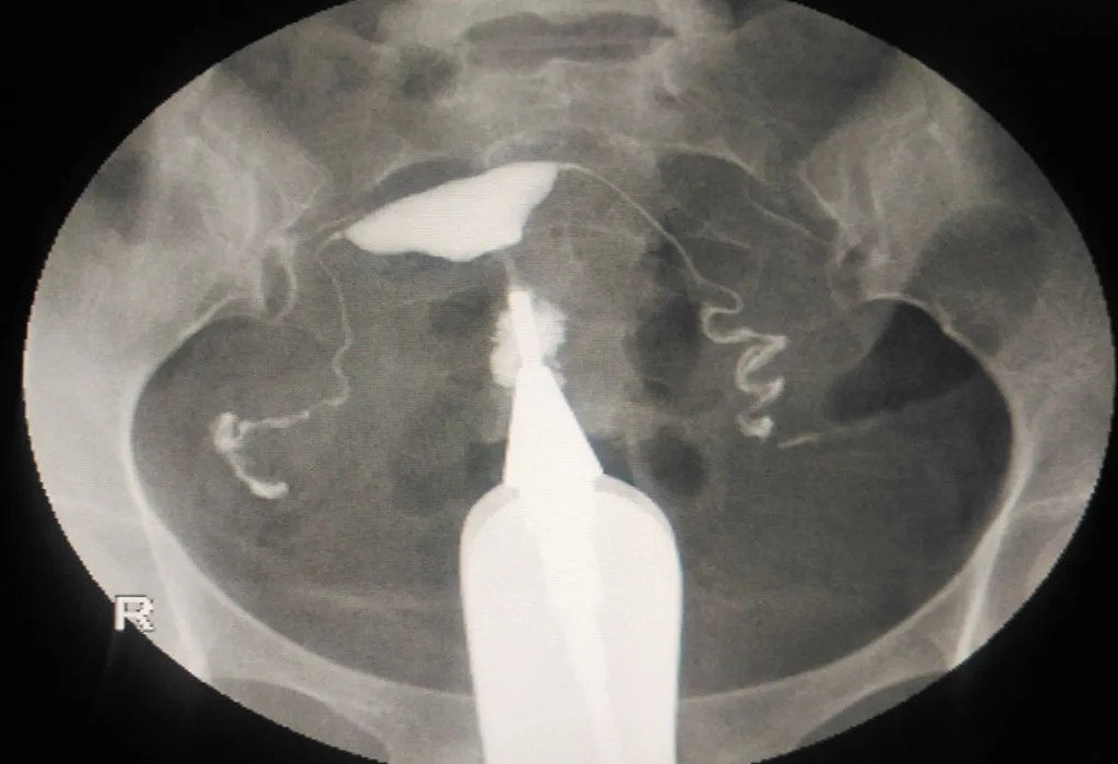 Ultrasound image of anteverted uterus Ultrasound image of anteverted uterus
