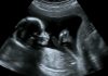 19 সপ্তাহের গর্ভবতীর আল্ট্রাসাউন্ড