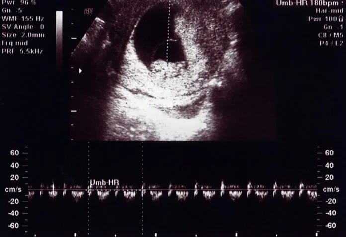 10 Weeks Pregnant Ultrasound
