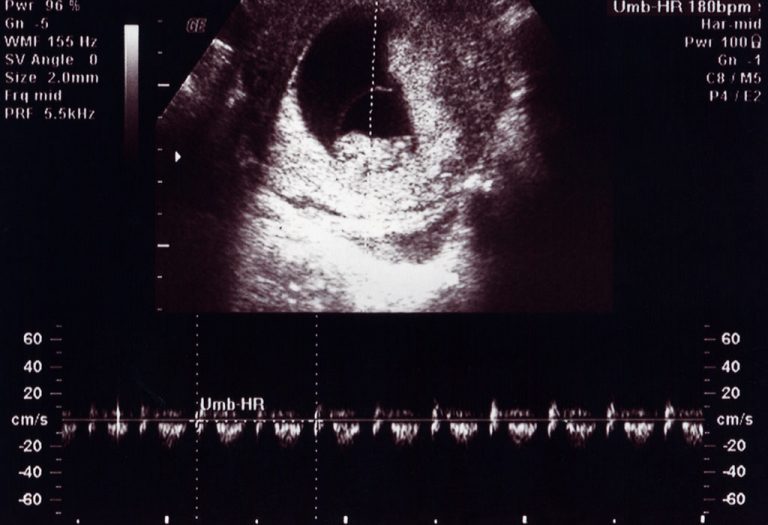 Ultrasound Scan at 10 Weeks of Pregnancy