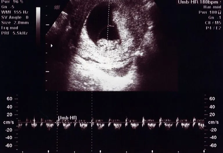 10 Weeks Pregnant Ultrasound Scan