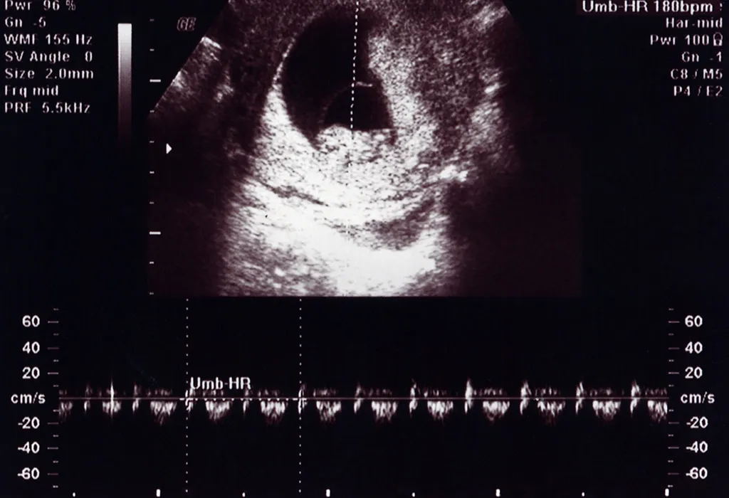 How accurate are dating scans at 6 weeks