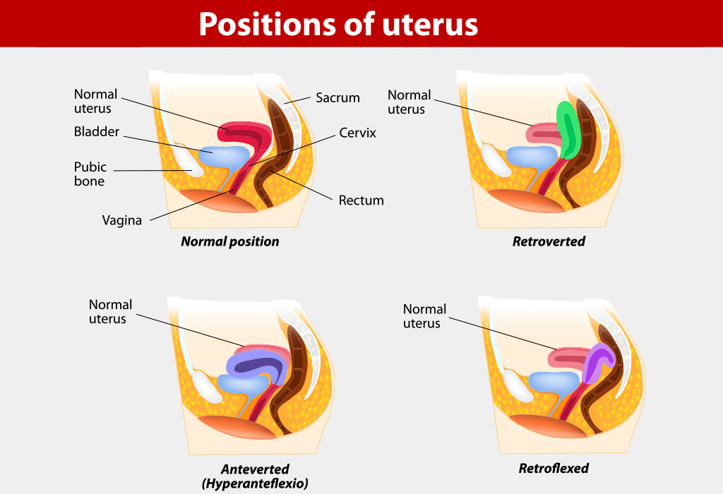 Antevertierter Uterus