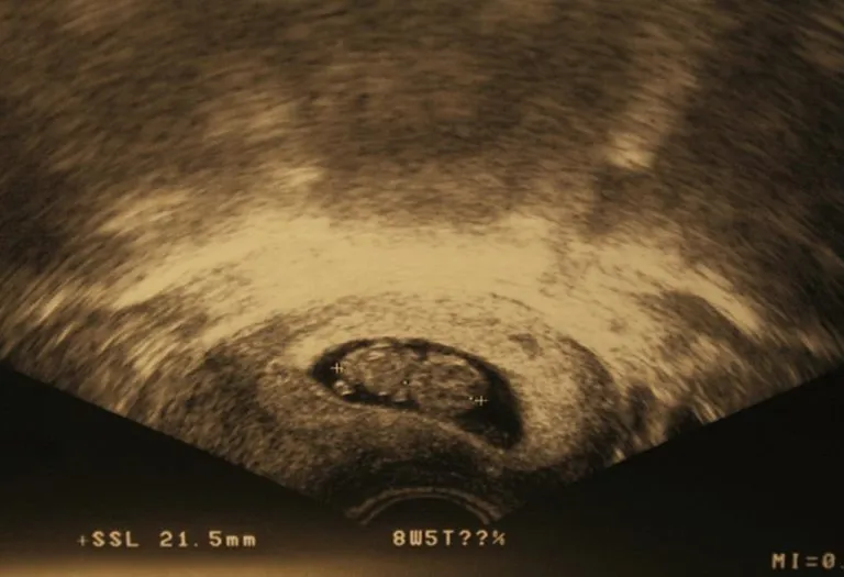 8 Weeks Pregnant Ultrasound Scan