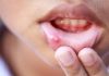 बच्चों के मुँह के छालों के लिए 14 प्रभावी घरेलू उपचार