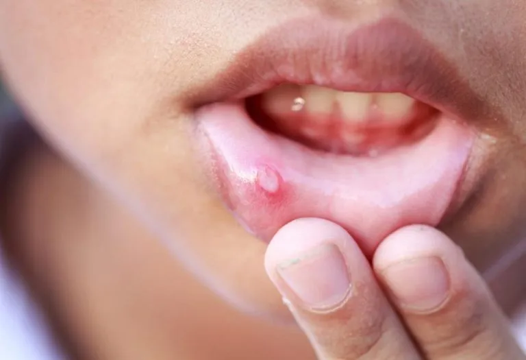 11 Home Remedies for Mouth Ulcers in Babies & Kids
