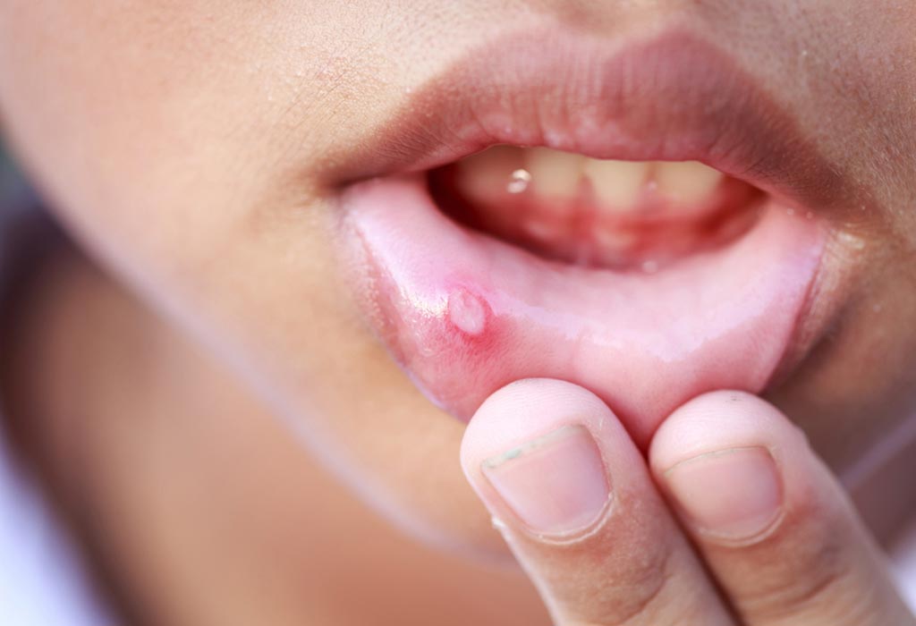 Home Remedies for Mouth Ulcers in Children