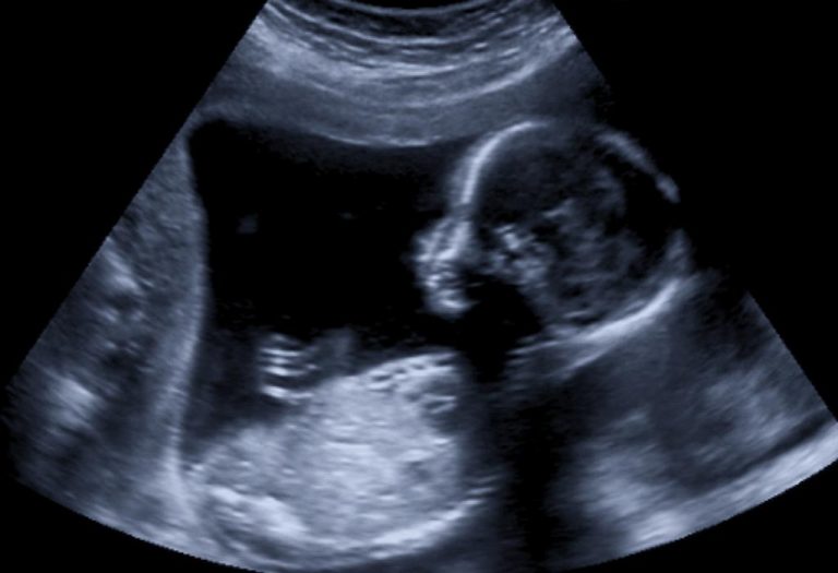 13 Weeks Pregnant Ultrasound Scan