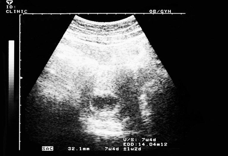 7 Weeks Pregnant Ultrasound Scan