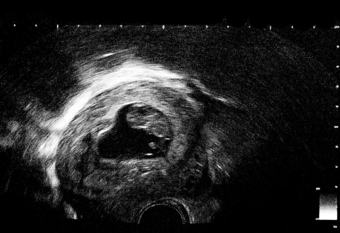 11 Weeks Pregnant Ultrasound