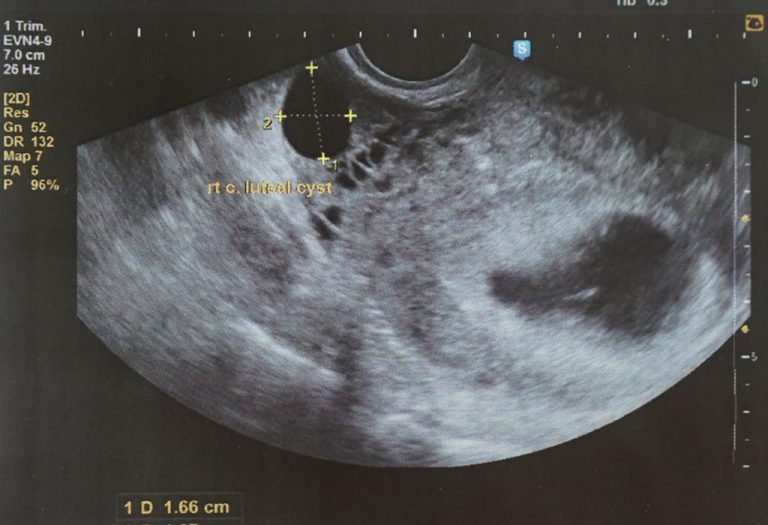 5 Weeks Pregnant Ultrasound Scan