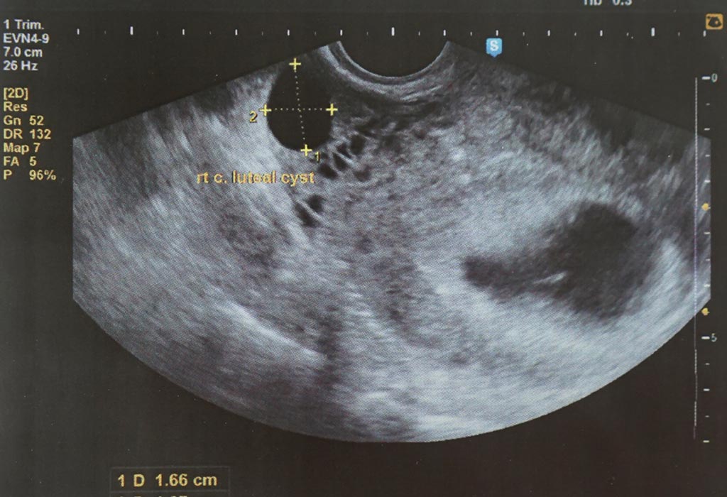 Weeks 4 ultrasound at First trimester