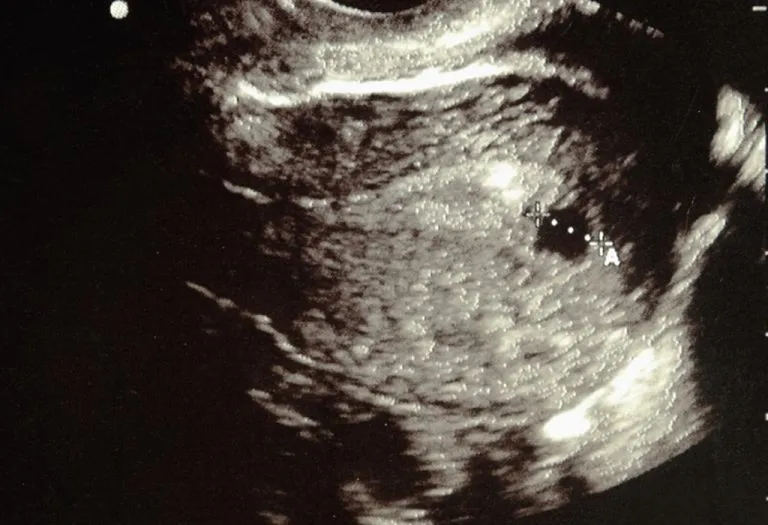 6 Weeks Ultrasound: Procedure, Abnormalities and more