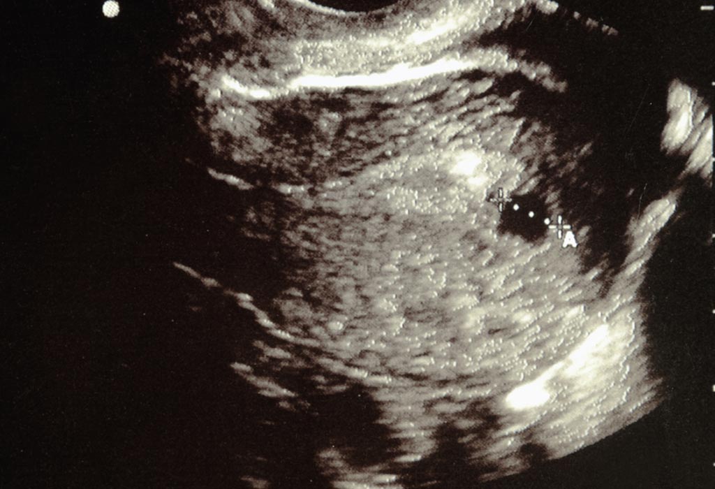 Date days weeks 2021 pregnant ultrasound 6 heartbeat best for ✔️ 4 due date
