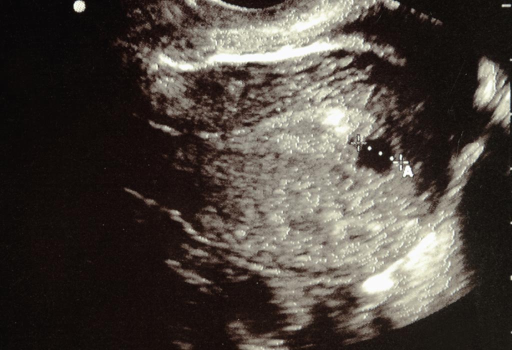 6 Week Ultrasound Heartbeat 