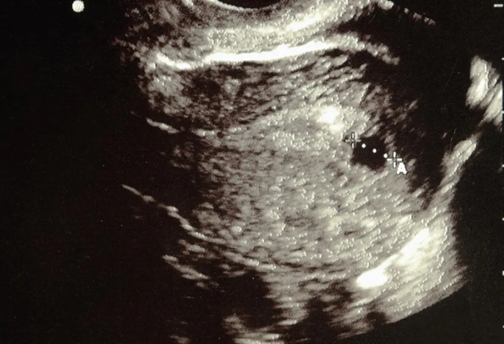 How accurate are dating scans at 6 weeks