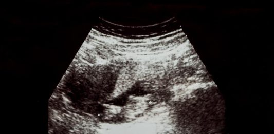गर्भावस्था के 9वें सप्ताह में अल्ट्रासाउंड प्रेगनेंसी के 9वें सप्ताह में अल्ट्रासाउंड