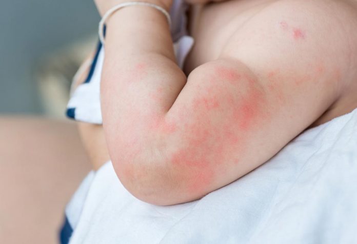 A baby with rashes on the arm