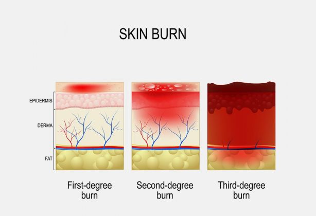 Burns in Children: Causes, Types, Treatment & Home Remedies