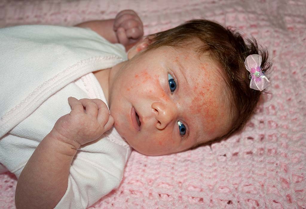 8 Home Remedies for a Rash on Baby’s Face