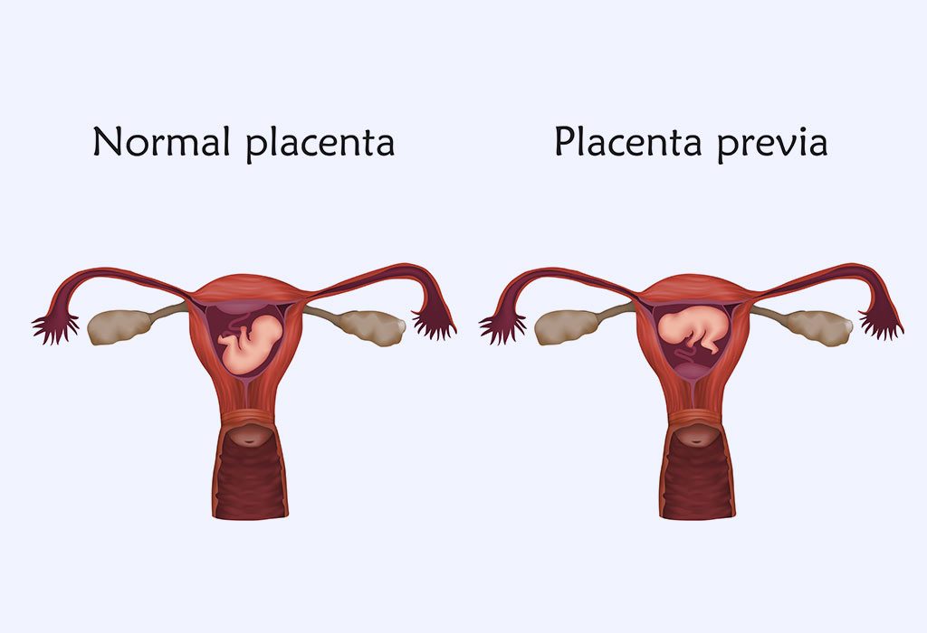 PLACENTA PREVIA