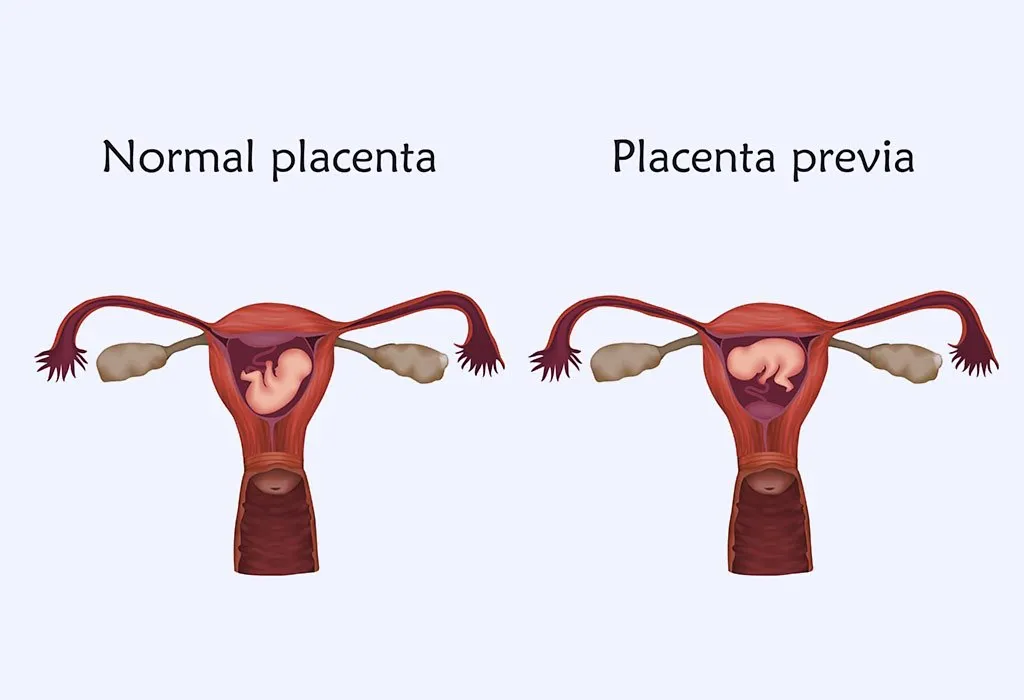 PLACENTA PREVIA PLACENTA PREVIA