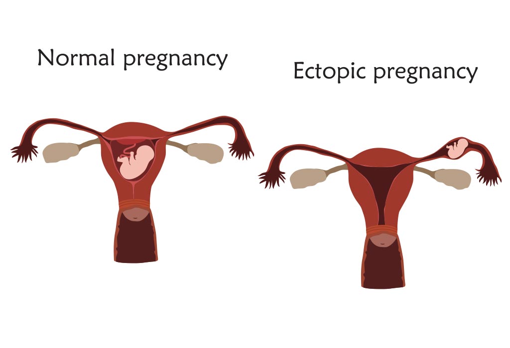 How Is Viable Or Nonviable Pregnancy Determined 