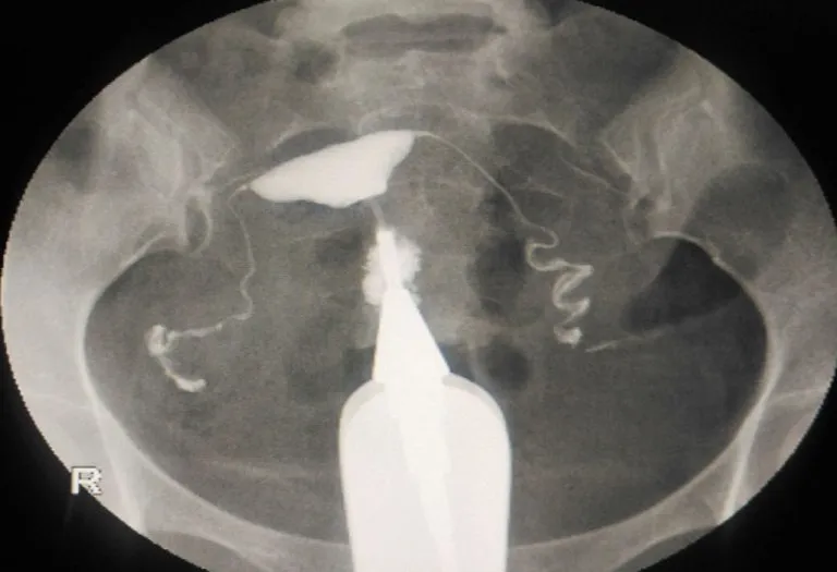 Chances of Getting Pregnant After an HSG (Hysterosalpingogram) Test