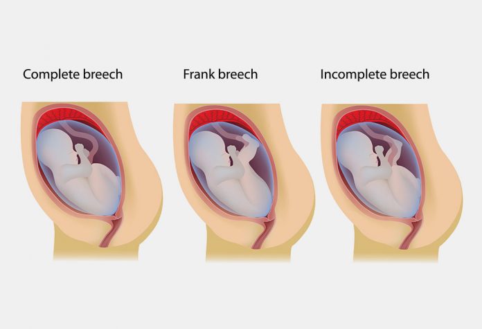 Breech baby positions