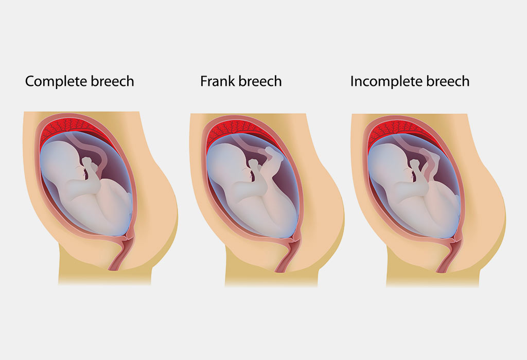 How To Turn A Breech Baby Naturally Techniques Exercises Tips