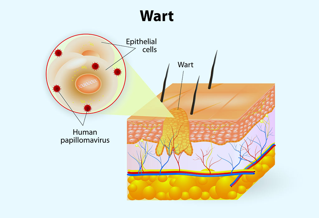 छोटे बच्चों में वार्ट्स कितने आम होते हैं और ये कहां बनते हैं? 