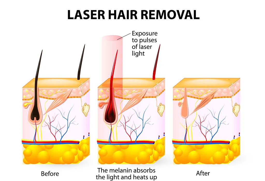 Probleme, die auftreten können, wenn Sie sich während der Schwangerschaft einer Laser-Haarentfernung unterziehen